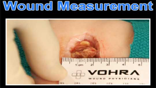 Wound Measurement